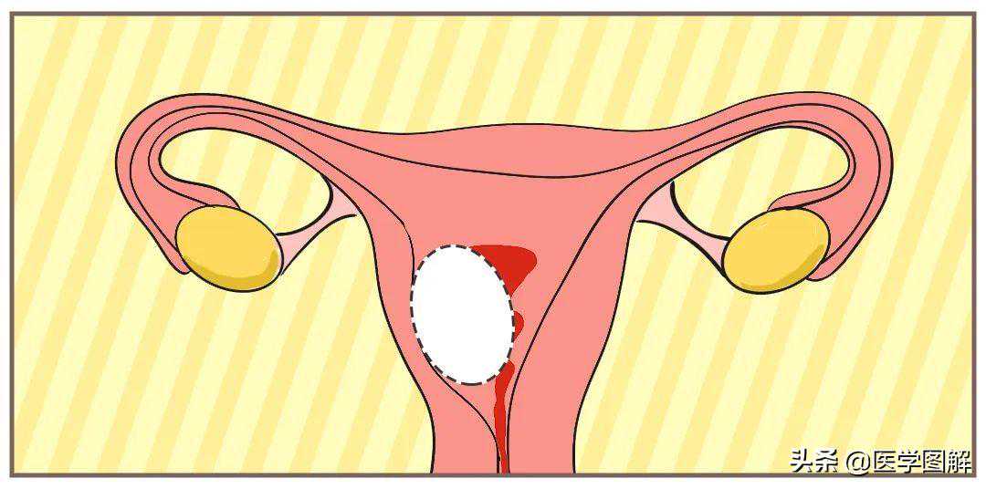 武汉代孕就找开心帼_子宫肌瘤，比你想象的可怕！瞬间就危在旦夕？丨医学图