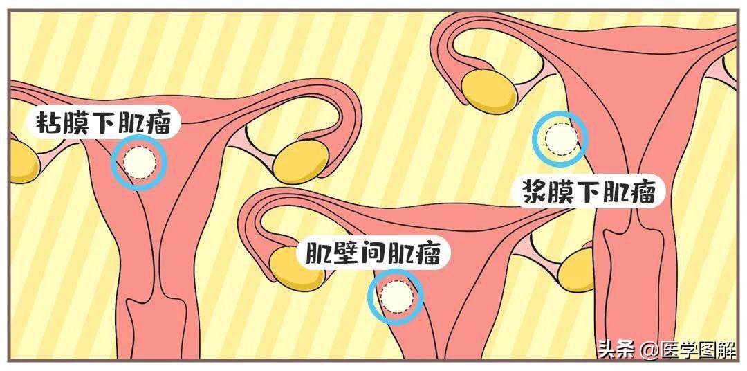 武汉代孕就找开心帼_子宫肌瘤，比你想象的可怕！瞬间就危在旦夕？丨医学图